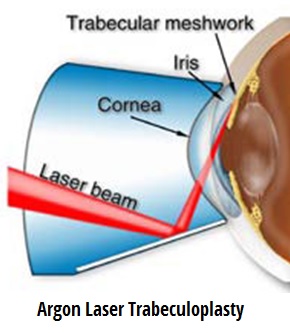 Laser επεμβάσεις γλαυκώματος