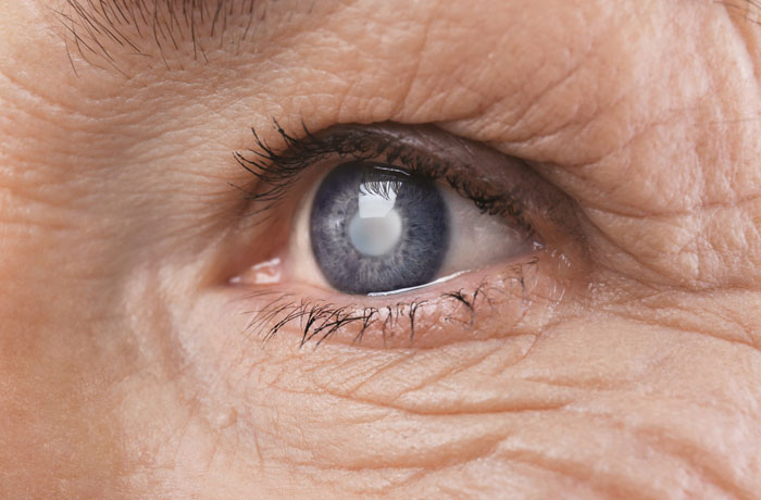Πότε αποκαθίσταται η όραση μετά από εγχείρηση καταρράκτη;