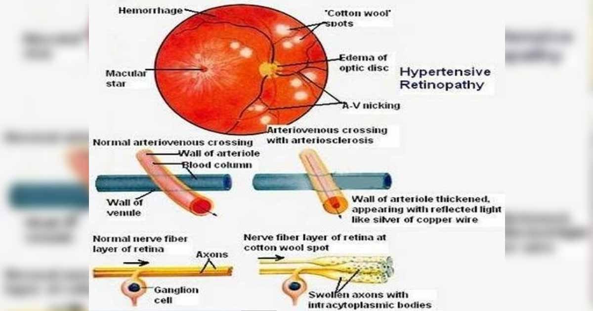 Πως η αρτηριακή πίεση επηρεάζει τα μάτια