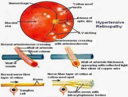 Πως η αρτηριακή πίεση επηρεάζει τα μάτια