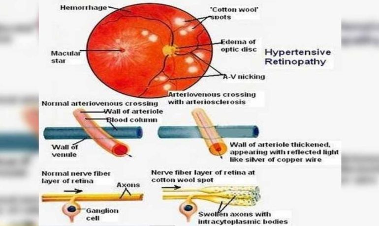 Πως η αρτηριακή πίεση επηρεάζει τα μάτια