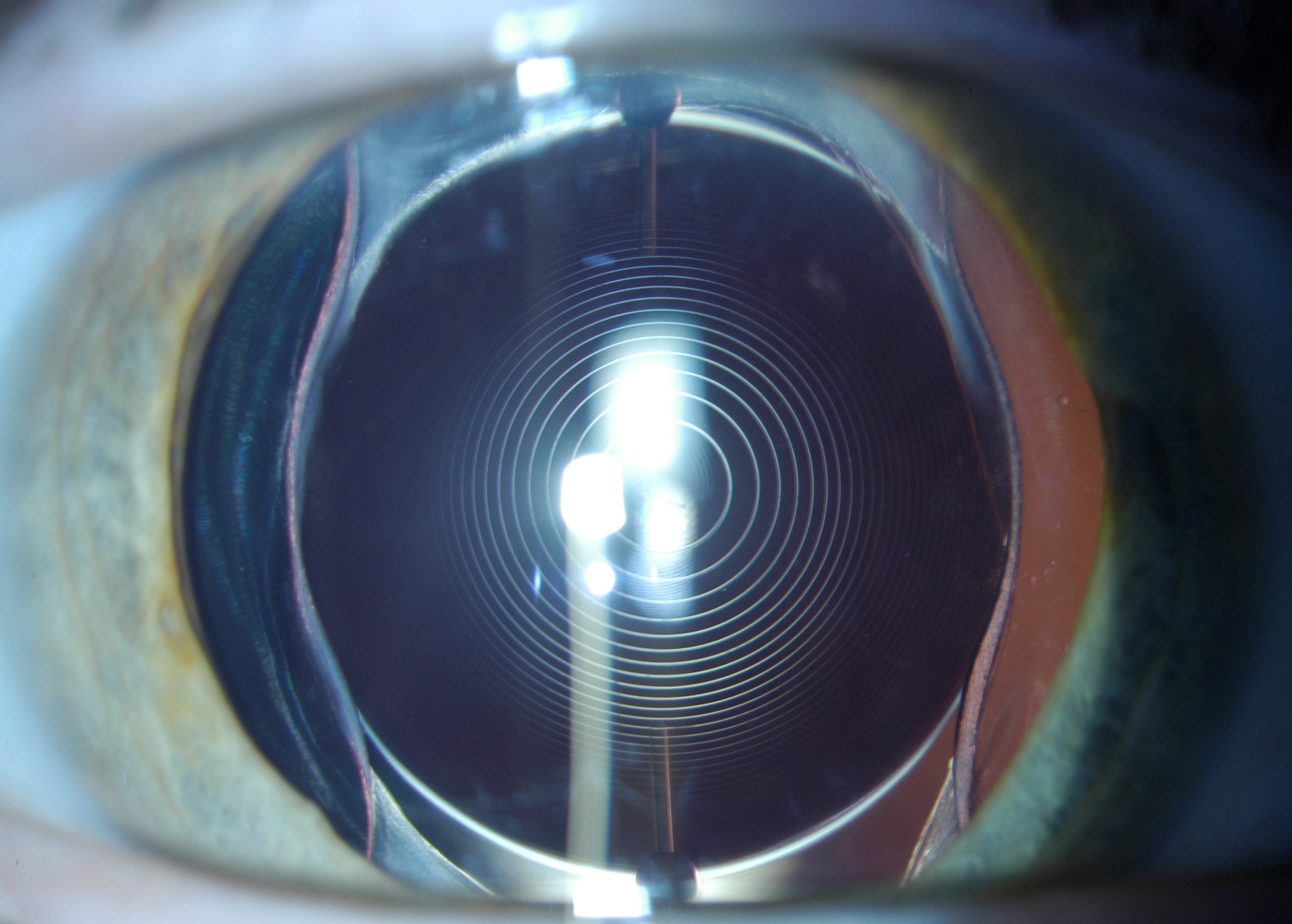 Мультифокальные линзы иол преимущества. Замена хрусталика мультифокальными линзами. Замена хрусталика мультифокальными линзами. Мультифокальная торическая иол. Замена хрусталика мультифокальными линзами.