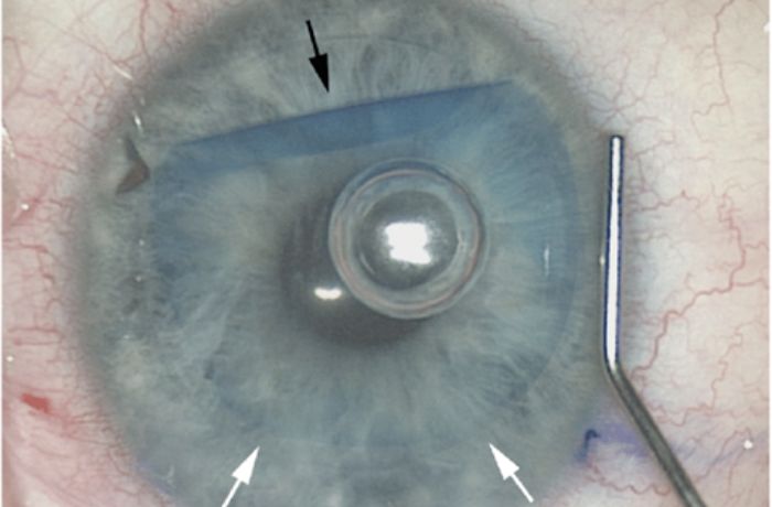 DMEK (Descemet membrane endothelial keratoplasty)