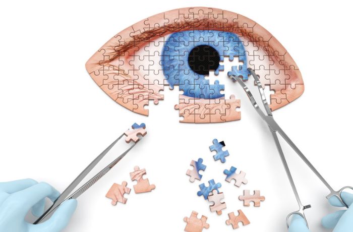 DSEK (Descemet Stripping Endothelial Keratoplasty)